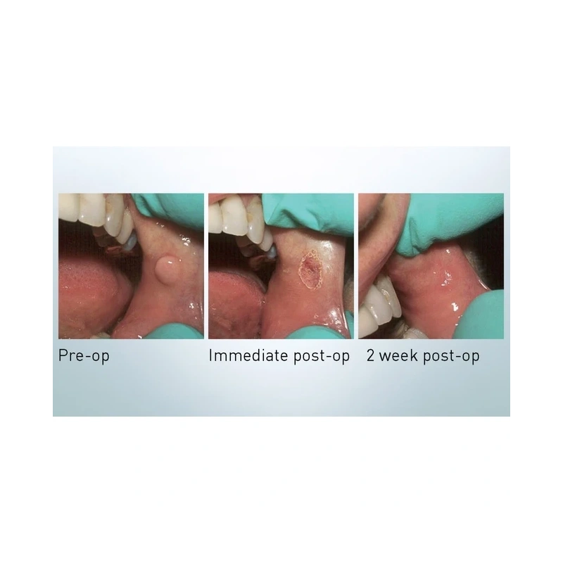 FONALaser - стоматологический диодный лазер | FONA Dental s.r.o. (Италия)
