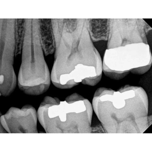 Kodak RVG 6200 - радиовизиограф, 24 пар линий/мм | Carestream Dental (США)