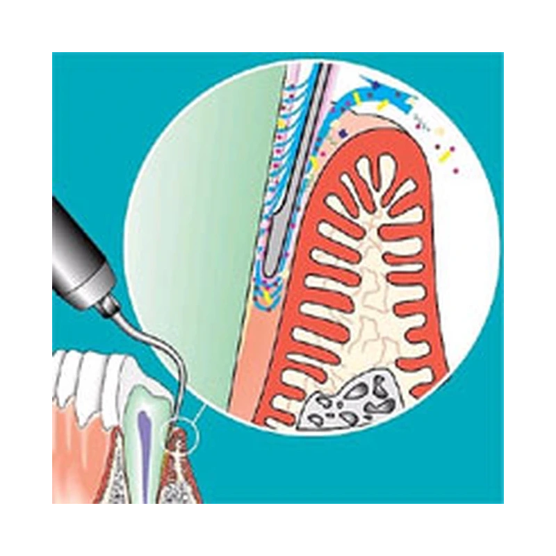 Sonicflex paro №61 - насадка с рабочим концом, изогнутым влево с закругленной верхушкой для минимально инвазивной терапии пародонтита | KaVo (Германия)