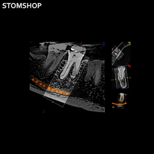 CS 8100 3D - дентальный трехмерный томограф, FOV 8х9 см | Carestream Dental (США)