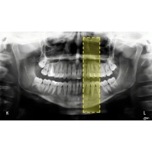 Hyperion X9 Pro 16х18 - дентальный цифровой 3D-томограф с цефалостатом, 3 в 1, FOV 16x18 | MyRay (Италия)