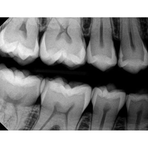 Kodak RVG 6200 - радиовизиограф, 24 пар линий/мм | Carestream Dental (США)