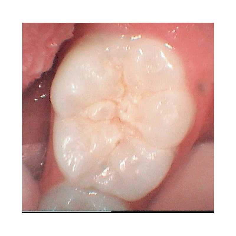 RONDOflex plus 360 - воздушно-абразивный наконечник | KaVo (Германия)