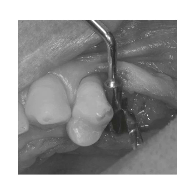 LM Implant Misura MR Kit - набор имплантологический | LM-Instruments Oy (Финляндия)