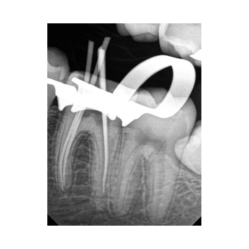 Kodak RVG 6200 - радиовизиограф, 24 пар линий/мм | Carestream Dental (США)