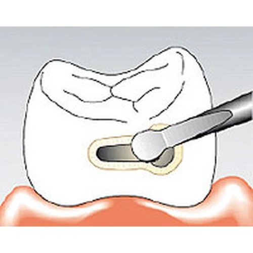 Sonicflex bevel №59 A - насадка для минимально инвазивной терапии кариеса с алмазным покрытием, дистальная | KaVo (Германия)