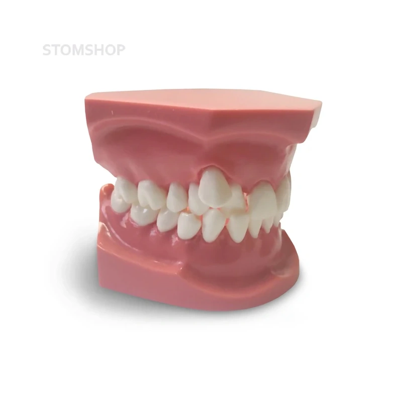 ORB05 – ортодонтическая модель с брекетами и твердой десной, 3 класс | GF Dental (Италия)