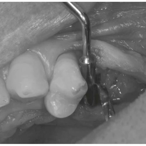 LM Implant Misura MR 3.3-5.6 - инструмент для позиционирования имплантатов | LM-Instruments Oy (Финляндия)