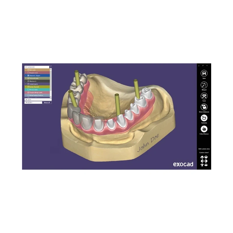 Exocad Implant Module - модуль для создания имплантов | Exocad (Германия)