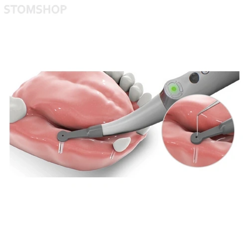 Implant Spotter – устройство для точной локализации центра импланта при двухэтапной имплантации | Forum Engineering Technologies Ltd. (Израиль)