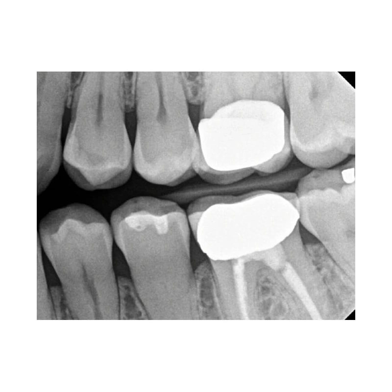 Kodak RVG 6200 - радиовизиограф, 24 пар линий/мм | Carestream Dental (США)