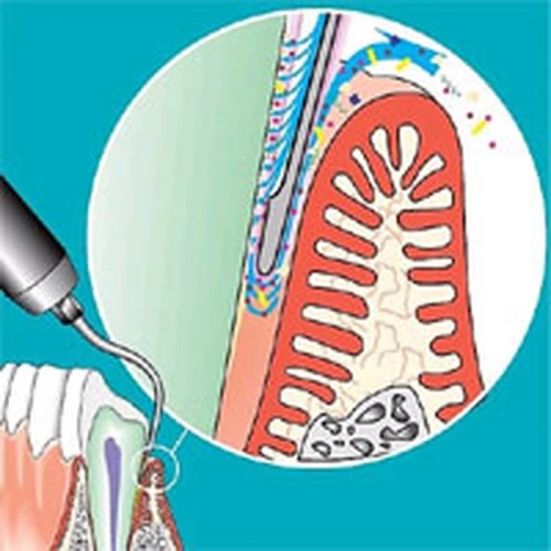 Sonicflex paro №60 A - длинная прямая насадка с закругленной верхушкой для минимально инвазивной терапии пародонтита | KaVo (Германия)