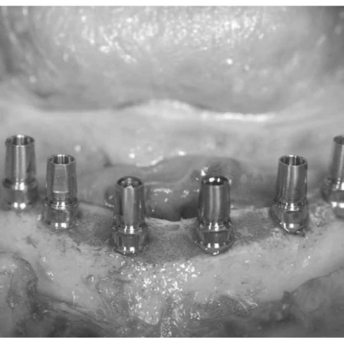 LM Implant Misura MR 3.7-6.3 - инструмент для позиционирования имплантатов | LM-Instruments Oy (Финляндия)